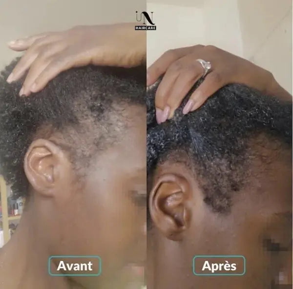 In Haircare avant/après Complément alimentaire Gummies Pousse Cheveux