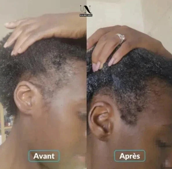 In Haircare Avant/Après Gummies pousse cheveux Cure 3 mois Goût pomme