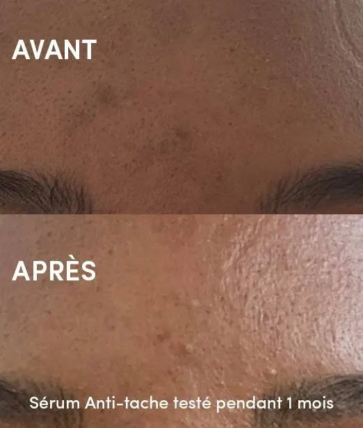 Efficacité du Sérum anti tache Visage après 1 mois d'utilisation sur peau noire WAAM Signature